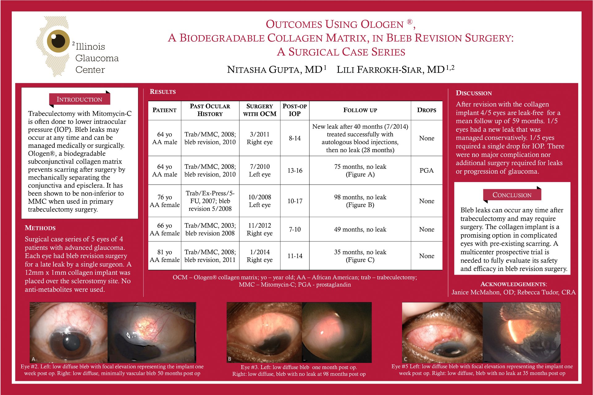 Outcomes using Ologen